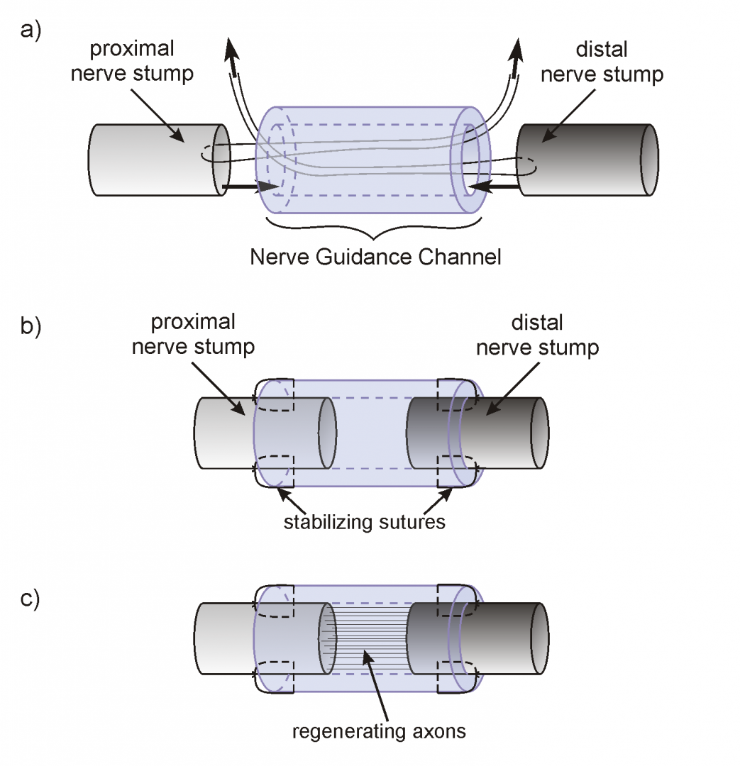 Tubulizacja – osłonkę nerwową nasuwa się na uszkodzone końce nerwu (stumps) i stabilizuje kilkoma szwami do onerwia 